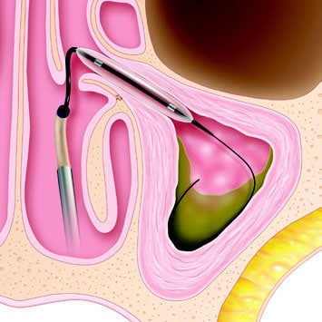 Illustration of balloon sinuplasty device in sinus cavity
